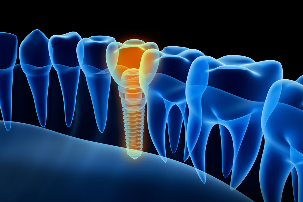 Diagnostic Digital Dental X-rays