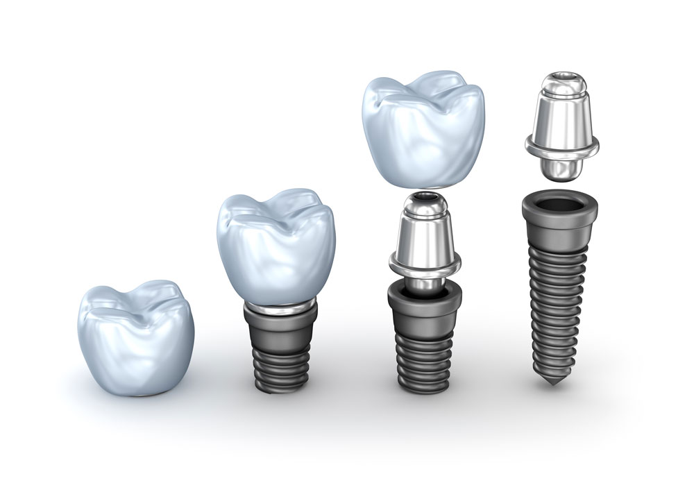 Dental Implants