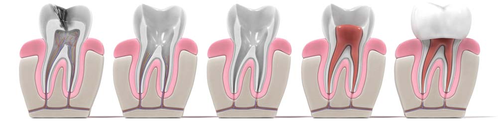 Root canal